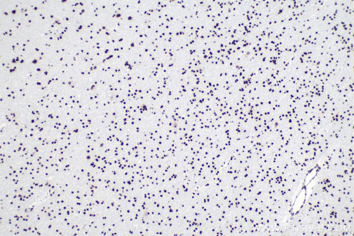 IHC analysis of human gliomas tissue using Proteintech’s TDP43 rabbit recombinant antibody (80001-1-RR) and IHC Detect Kit for Rabbit Primary Antibody (PK10009).