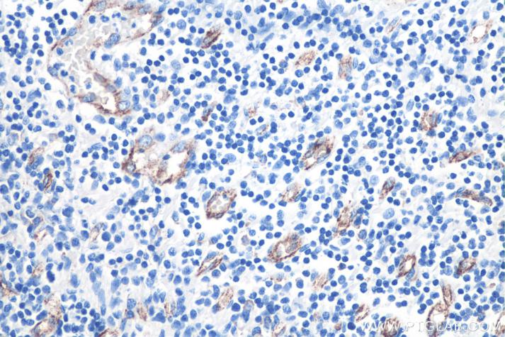 IHC analysis of human tonsilltis tissue with Proteintech’s VWF rabbit polyclonal antibody (27186-1-AP). Protease-induced epitope retrieval was performed by incubating at 37°C for 5 minutes in Protease K Antigen Retrieval Buffer (PR30014).
