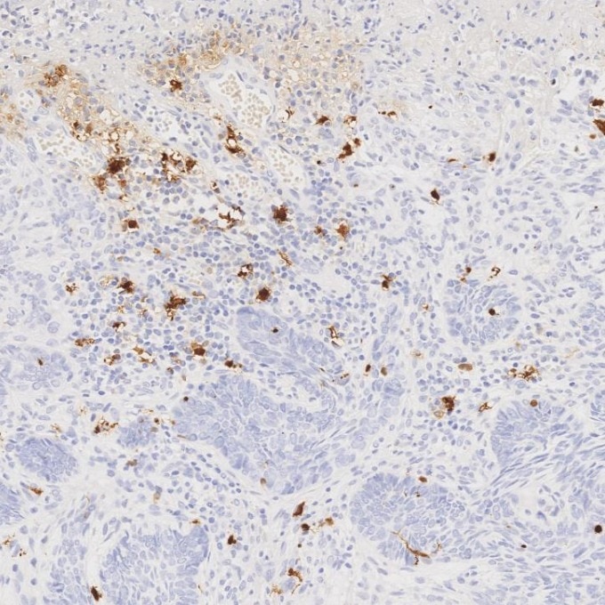 IHC staining of human skin cancer using 82271-8-RR Immunohistochemistry (IHC) staining of human skin cancer tissue using S100B Recombinant monoclonal antibody (82271-8-RR)
