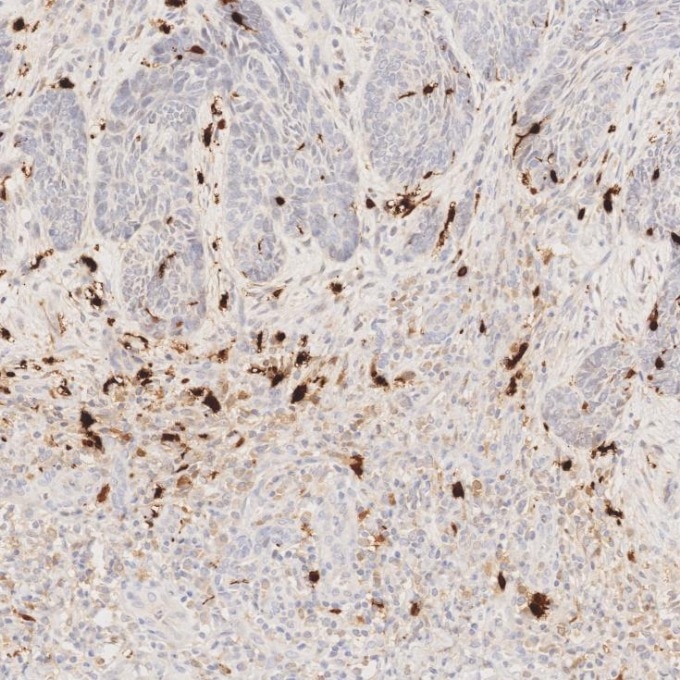 IHC staining of human skin cancer using 82271-8-RR Immunohistochemistry (IHC) staining of human skin cancer tissue using S100B Recombinant monoclonal antibody (82271-8-RR)
