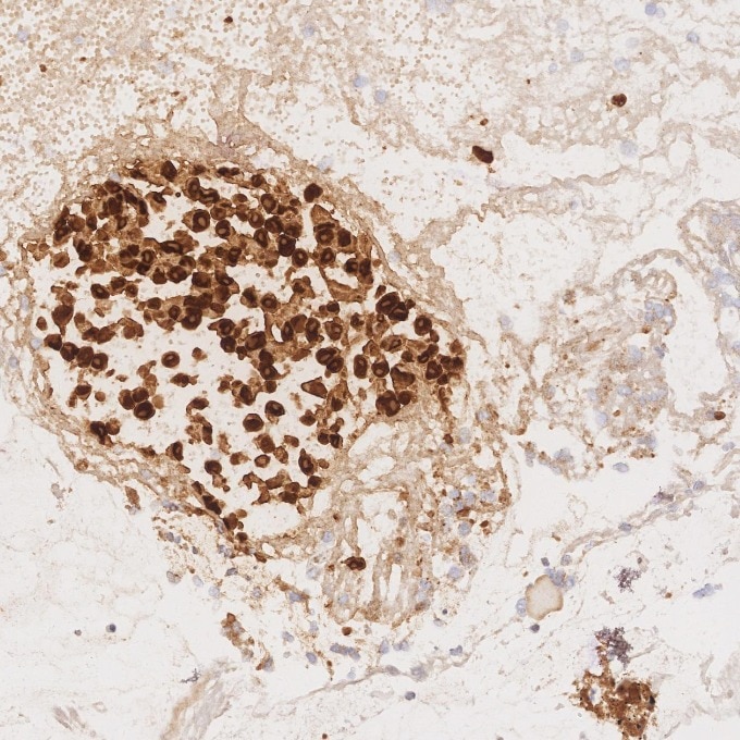 IHC staining of human malignant melanoma using 82271-8-RR Immunohistochemistry (IHC) staining of human malignant melanoma tissue using S100B Recombinant monoclonal antibody (82271-8-RR)