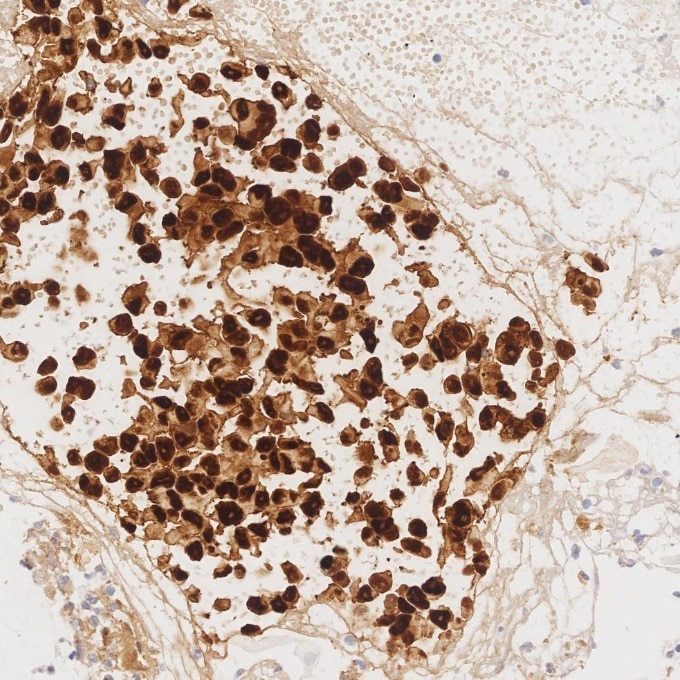 IHC staining of human malignant melanoma using 82271-8-RR Immunohistochemistry (IHC) staining of human malignant melanoma tissue using S100B Recombinant monoclonal antibody (82271-8-RR)