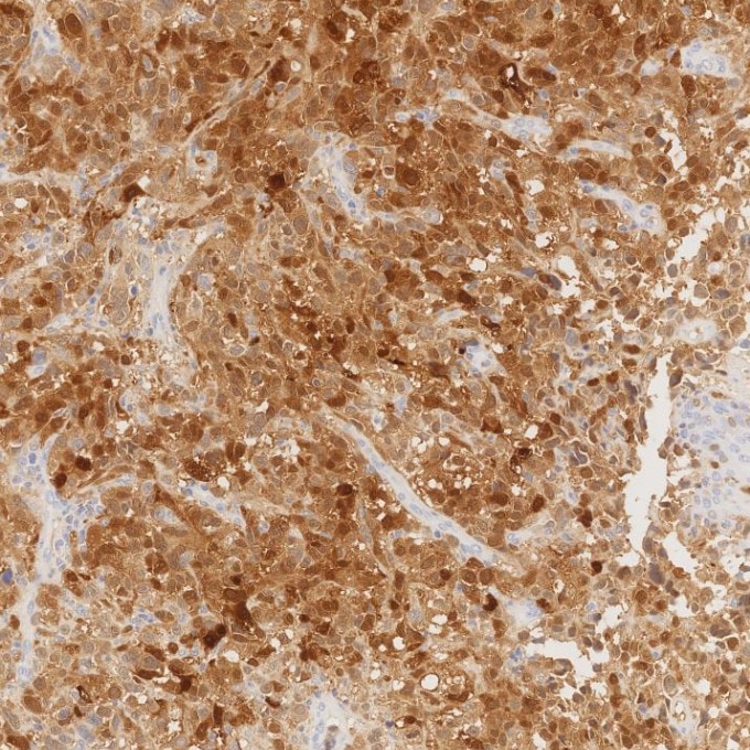 IHC staining of human malignant melanoma using 82271-8-RR Immunohistochemistry (IHC) staining of human malignant melanoma tissue using S100B Recombinant monoclonal antibody (82271-8-RR)