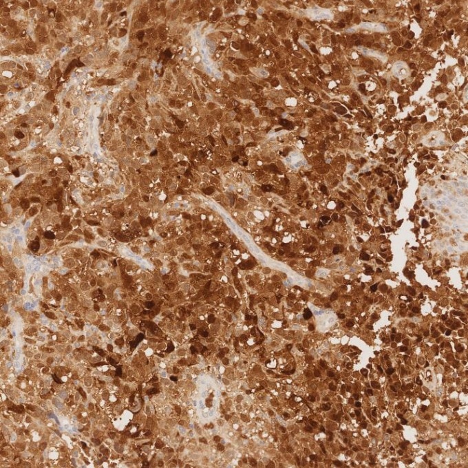 IHC staining of human malignant melanoma using 82271-8-RR Immunohistochemistry (IHC) staining of human malignant melanoma tissue using S100B Recombinant monoclonal antibody (82271-8-RR)