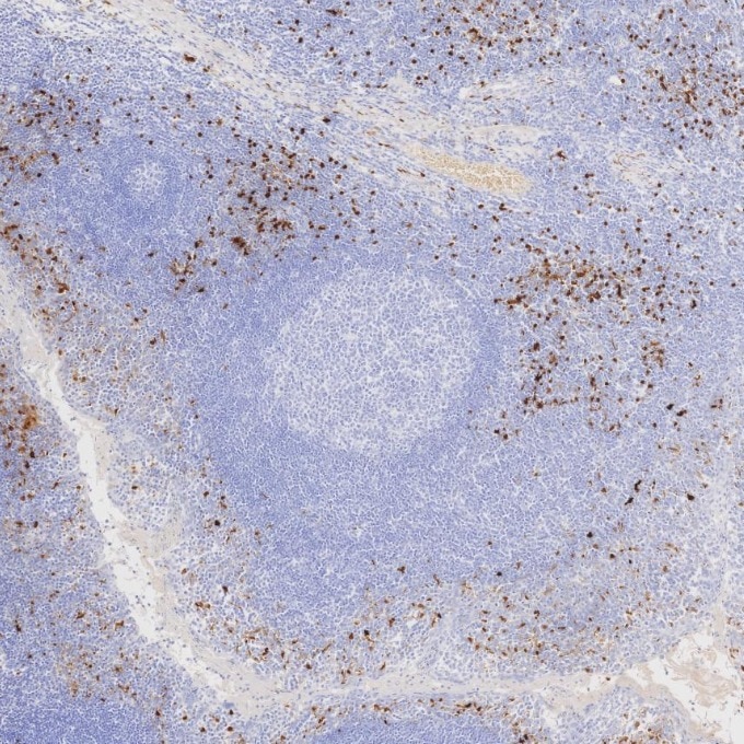 IHC staining of human tonsillitis using 82271-8-RR Immunohistochemistry (IHC) staining of human tonsillitis tissue using S100B Recombinant monoclonal antibody (82271-8-RR)