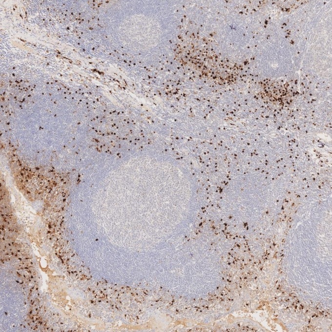 IHC staining of human tonsillitis using 82271-8-RR Immunohistochemistry (IHC) staining of human tonsillitis tissue using S100B Recombinant monoclonal antibody (82271-8-RR)