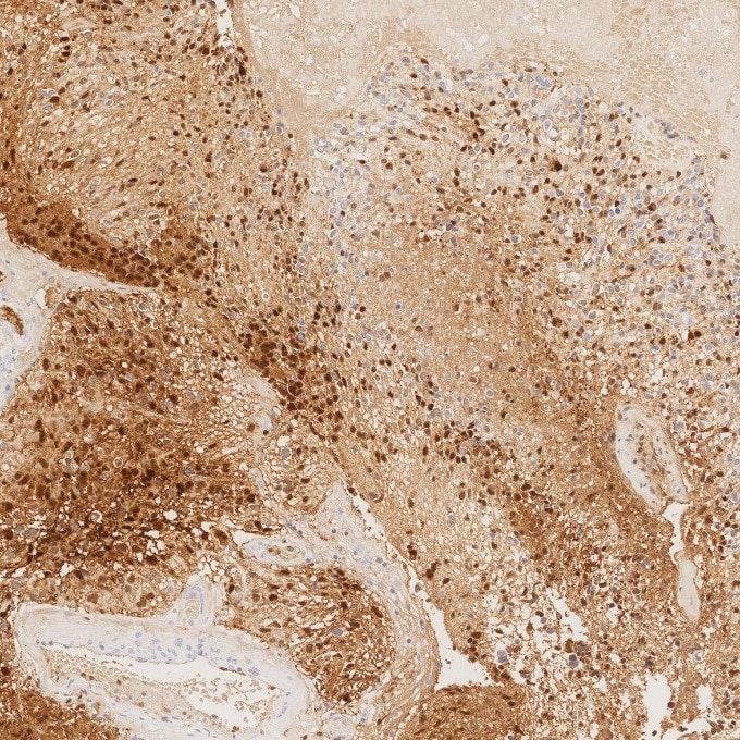 IHC staining of human gliomas using 82271-8-RR Immunohistochemistry (IHC) staining of human gliomas tissue using S100B Recombinant monoclonal antibody (82271-8-RR)