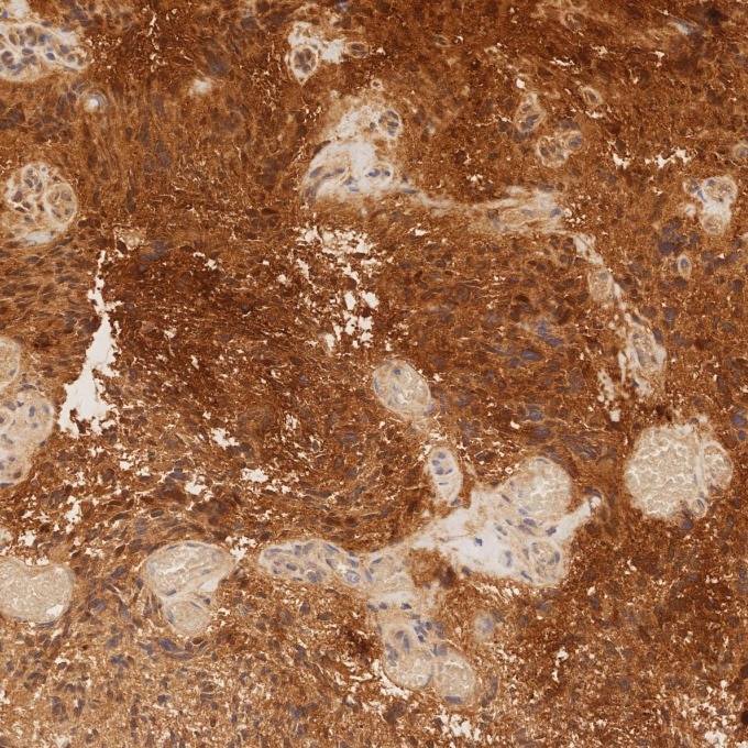 IHC staining of human gliomas using 82271-8-RR Immunohistochemistry (IHC) staining of human gliomas tissue using S100B Recombinant monoclonal antibody (82271-8-RR)