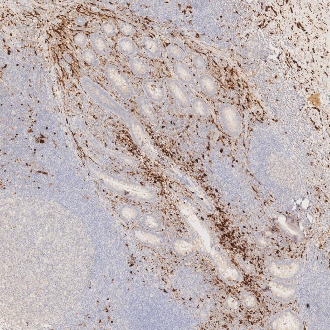IHC staining of human appendicitis using 82271-8-RR Immunohistochemistry (IHC) staining of human appendicitis tissue using S100B Recombinant monoclonal antibody (82271-8-RR)