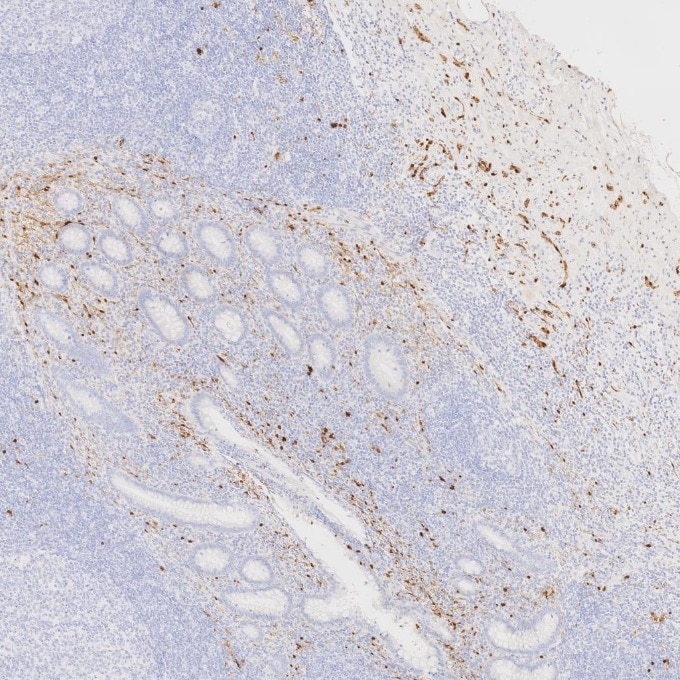 IHC staining of human appendicitis using 82271-8-RR Immunohistochemistry (IHC) staining of human appendicitis tissue using S100B Recombinant monoclonal antibody (82271-8-RR)