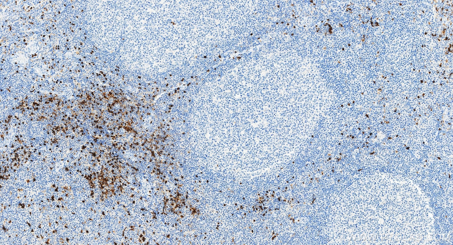 Immunohistochemistry (IHC) staining of human tonsillitis tissue using S100B Recombinant monoclonal antibody (82271-8-RR)