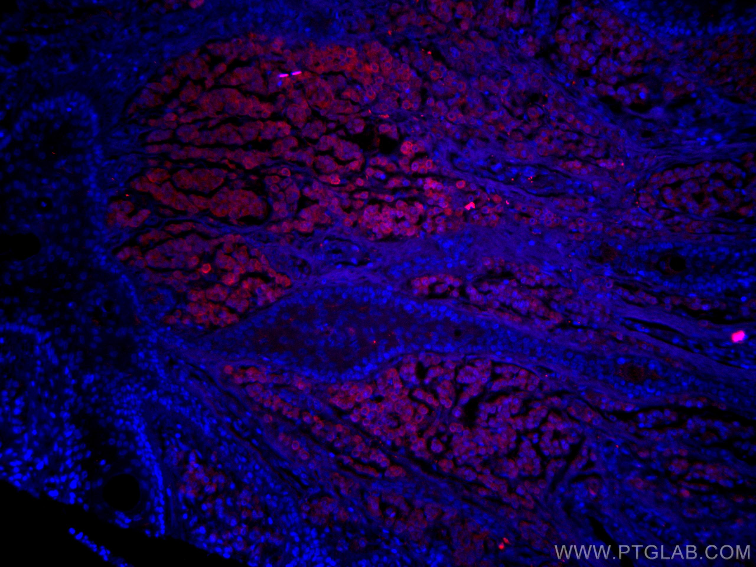 Immunofluorescence (IF) / fluorescent staining of human malignant melanoma tissue using CoraLite®594-conjugated S100 Beta Polyclonal antib (CL594-15146)