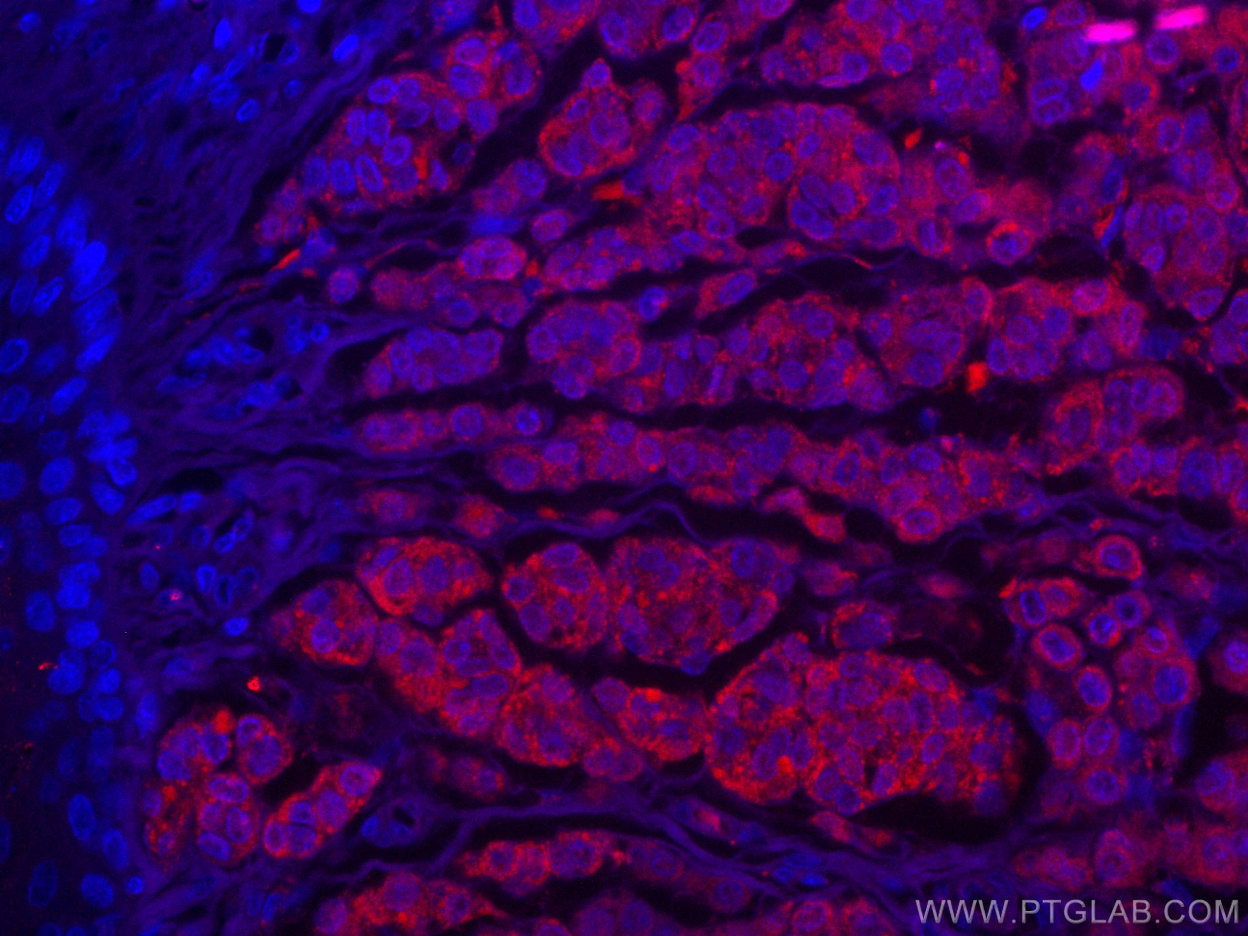 IF Staining of human malignant melanoma using CL594-15146