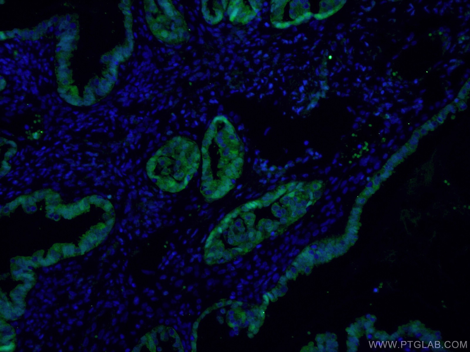 Immunofluorescence (IF) / fluorescent staining of human ovary cancer tissue using S100A1 Polyclonal antibody (16027-1-AP)