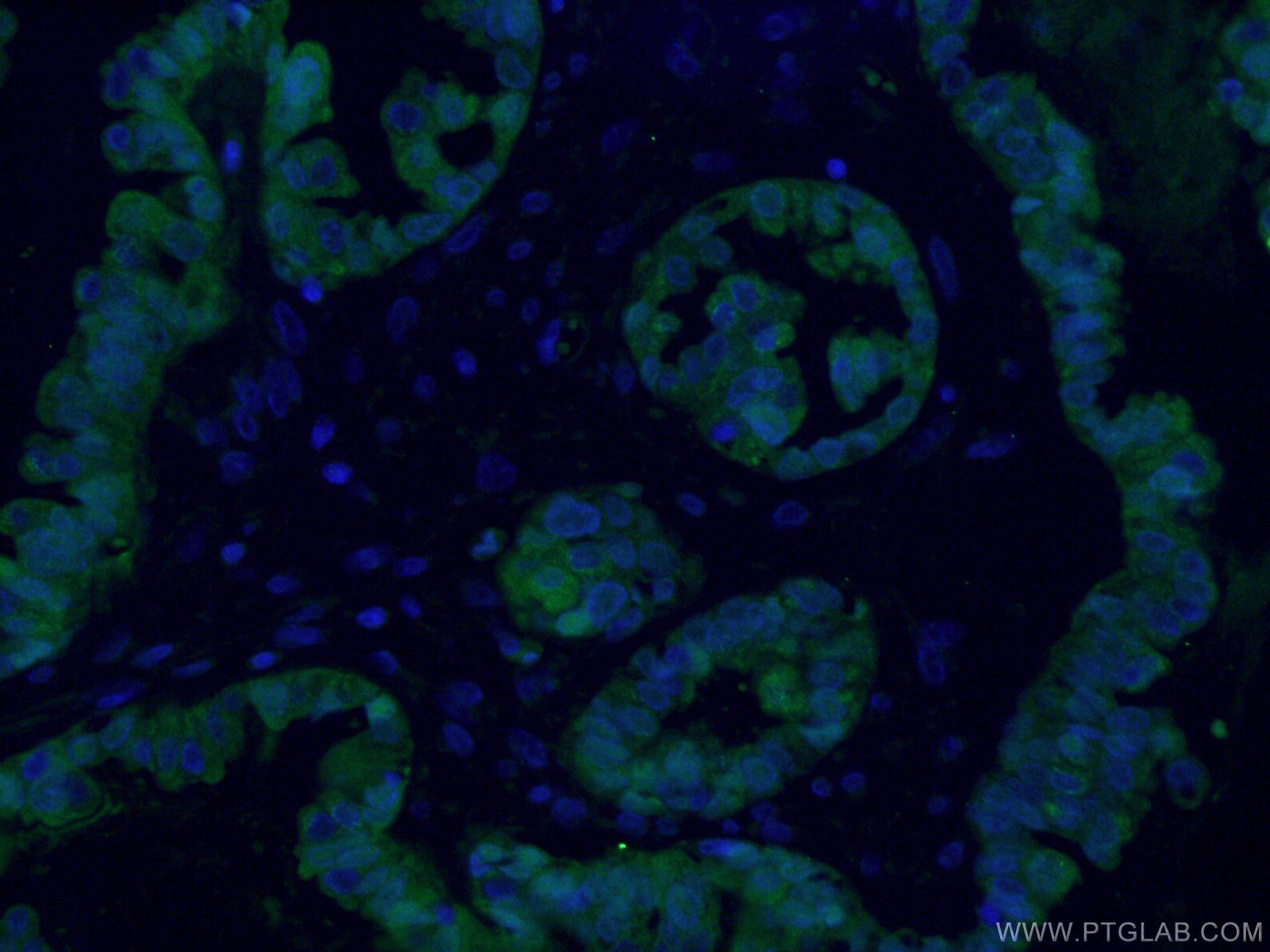 Immunofluorescence (IF) / fluorescent staining of human ovary cancer tissue using S100A1 Polyclonal antibody (16027-1-AP)