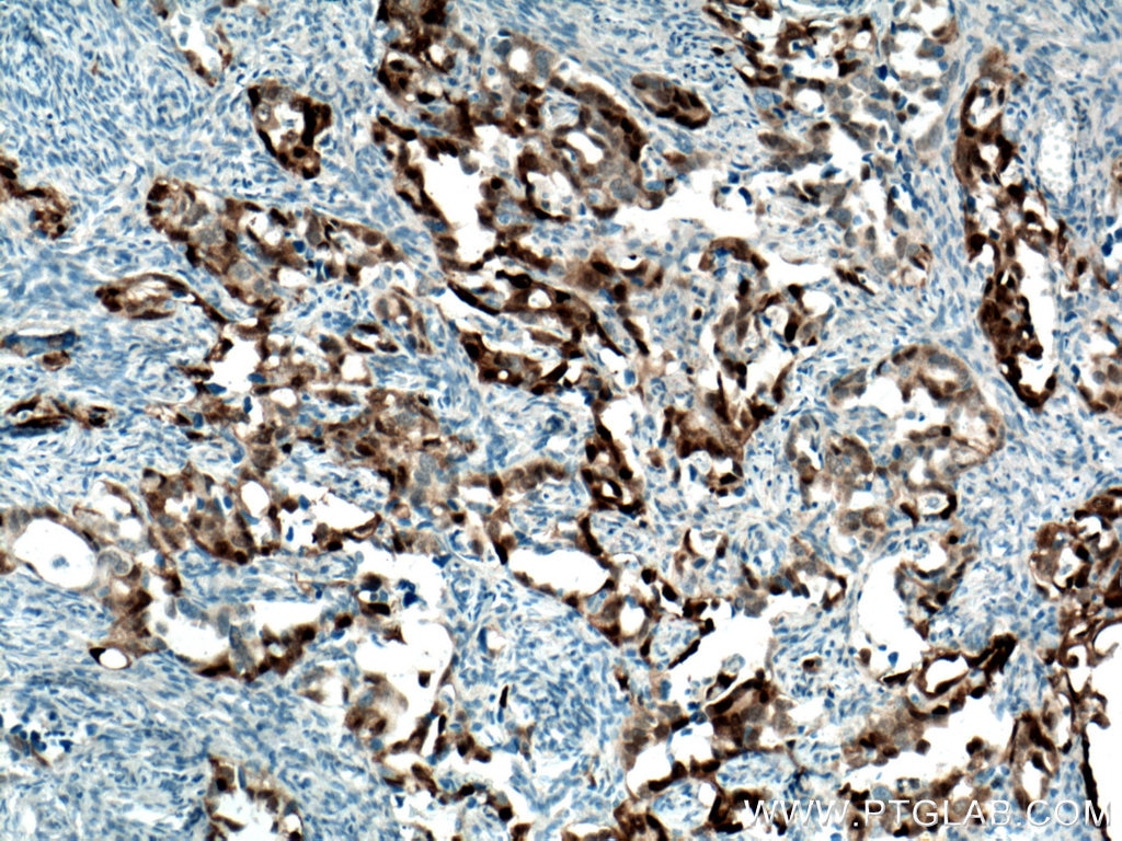 Immunohistochemistry (IHC) staining of human ovary tumor tissue using S100A1 Polyclonal antibody (16027-1-AP)