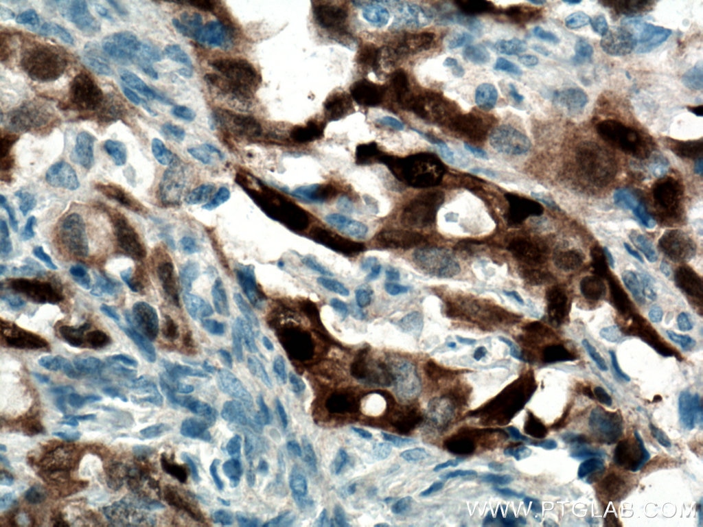 Immunohistochemistry (IHC) staining of human ovary tumor tissue using S100A1 Polyclonal antibody (16027-1-AP)