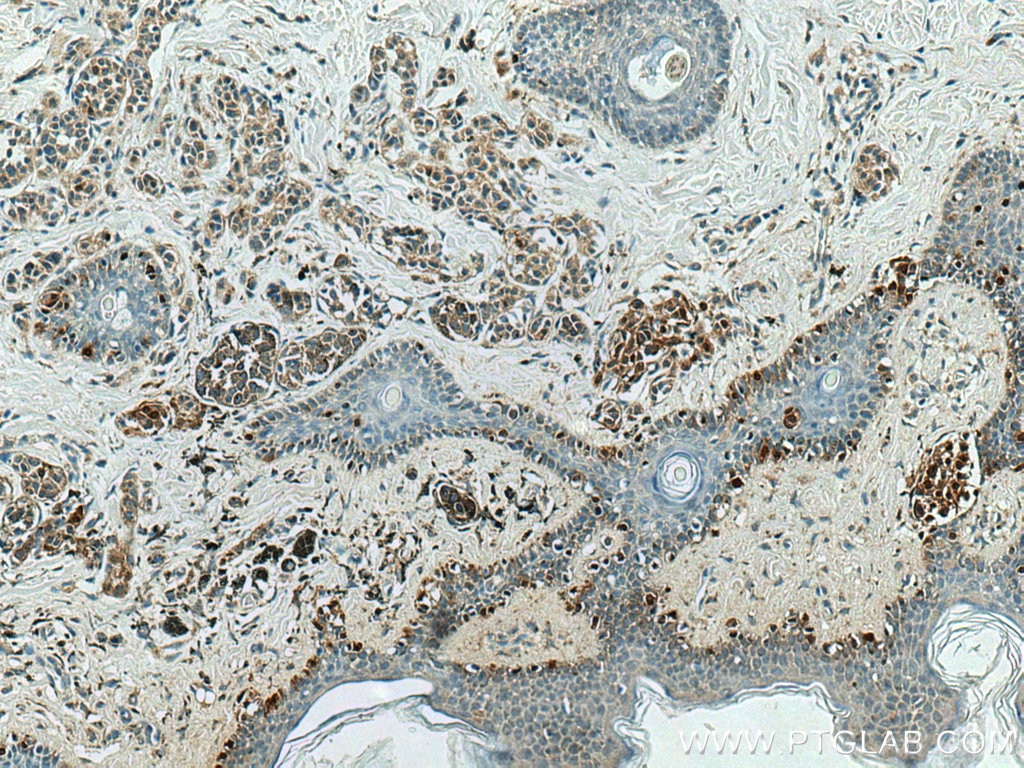 Immunohistochemistry (IHC) staining of human malignant melanoma tissue using S100A1 Polyclonal antibody (16027-1-AP)