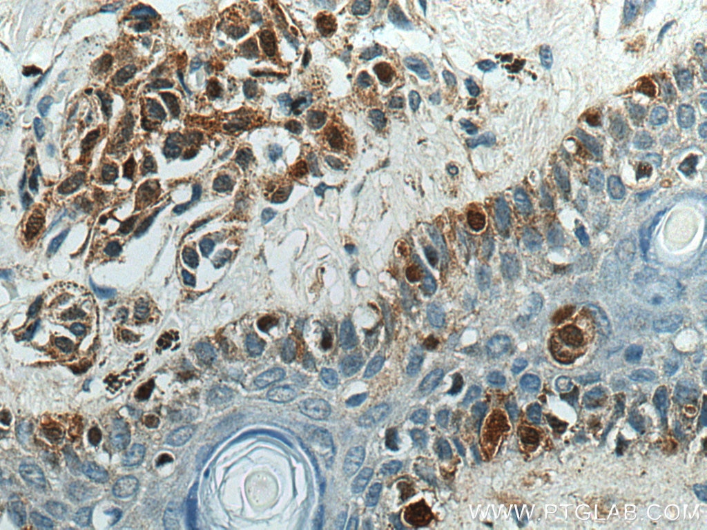 Immunohistochemistry (IHC) staining of human malignant melanoma tissue using S100A1 Polyclonal antibody (16027-1-AP)