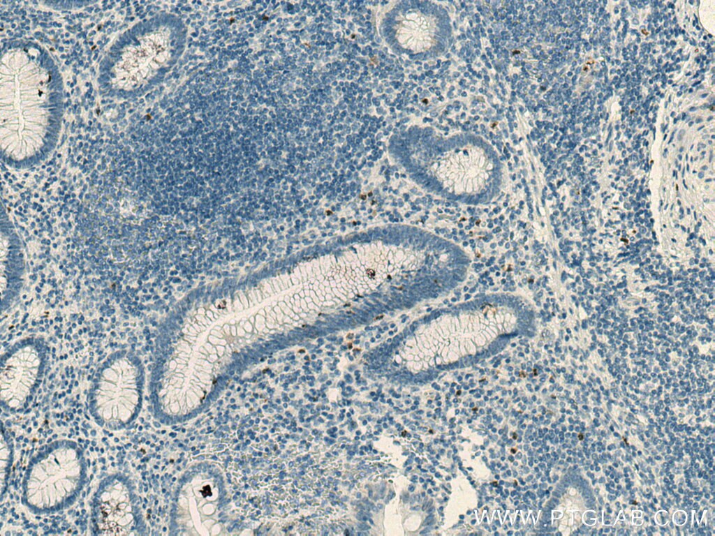 IHC staining of human appendicitis using 16027-1-AP