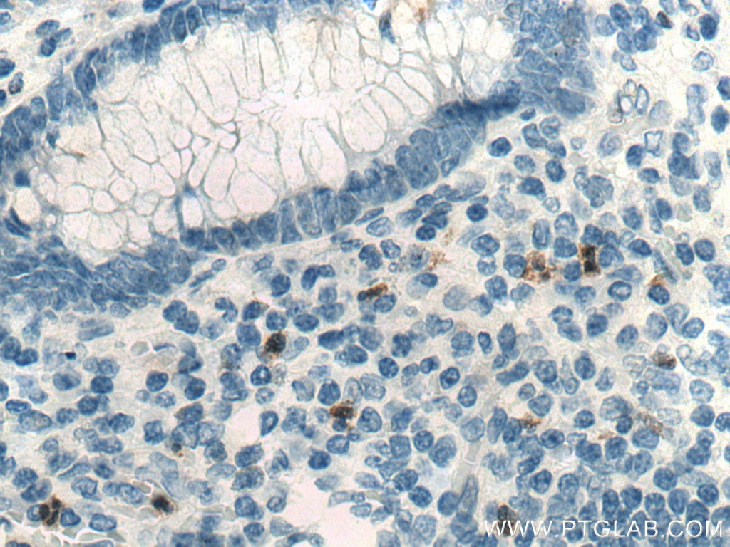 Immunohistochemistry (IHC) staining of human appendicitis tissue using S100A1 Polyclonal antibody (16027-1-AP)