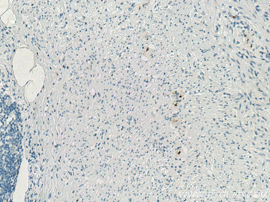 Immunohistochemistry (IHC) staining of human appendicitis tissue using S100A1 Polyclonal antibody (16027-1-AP)