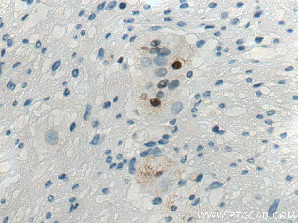 Immunohistochemistry (IHC) staining of human appendicitis tissue using S100A1 Polyclonal antibody (16027-1-AP)