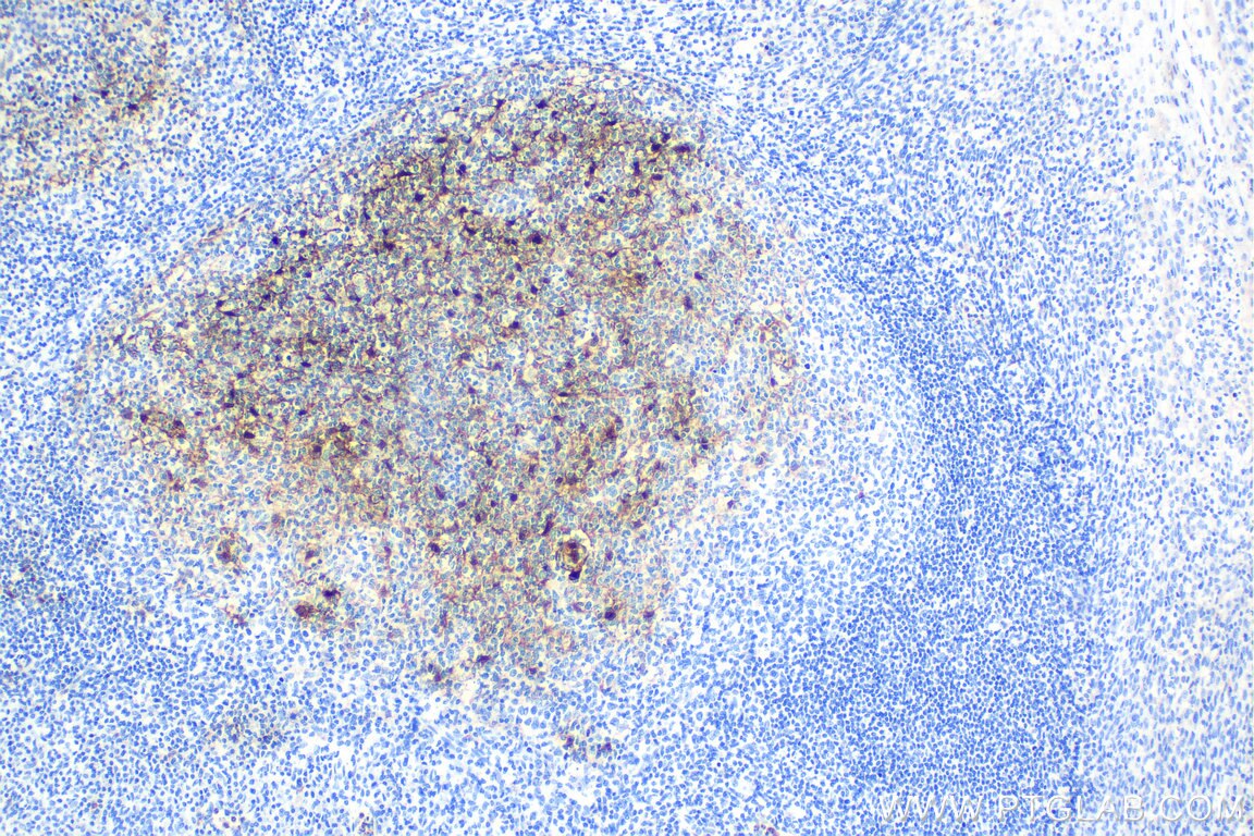 IHC staining of human tonsillitis using 16027-1-AP