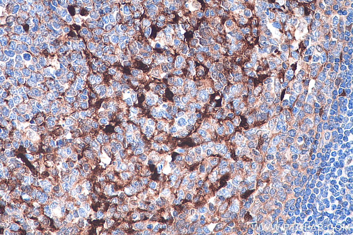 Immunohistochemistry (IHC) staining of human tonsillitis tissue using S100A1 Polyclonal antibody (16027-1-AP)