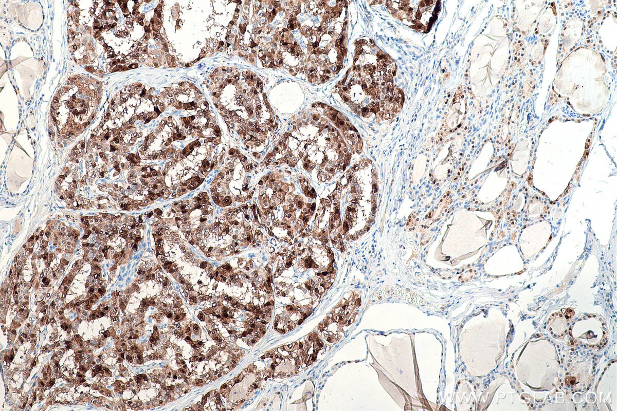Immunohistochemistry (IHC) staining of human thyroid cancer tissue using S100A1 Polyclonal antibody (16027-1-AP)