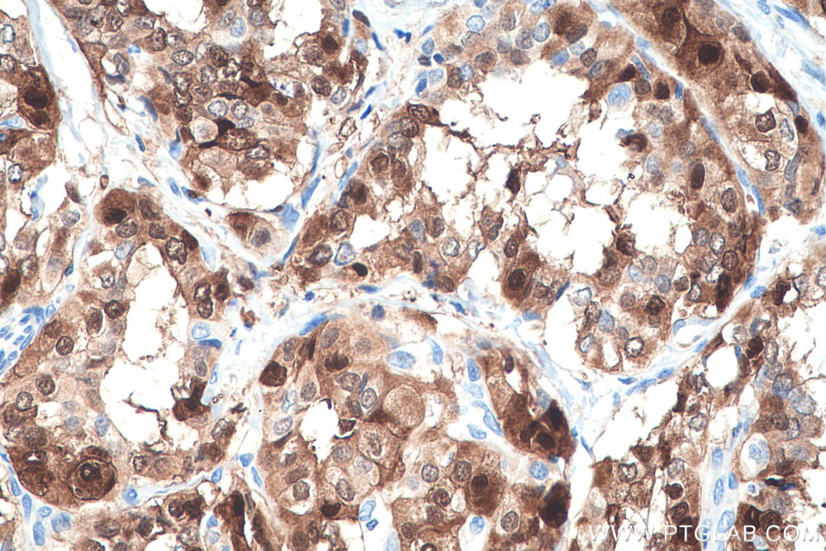 Immunohistochemistry (IHC) staining of human thyroid cancer tissue using S100A1 Polyclonal antibody (16027-1-AP)