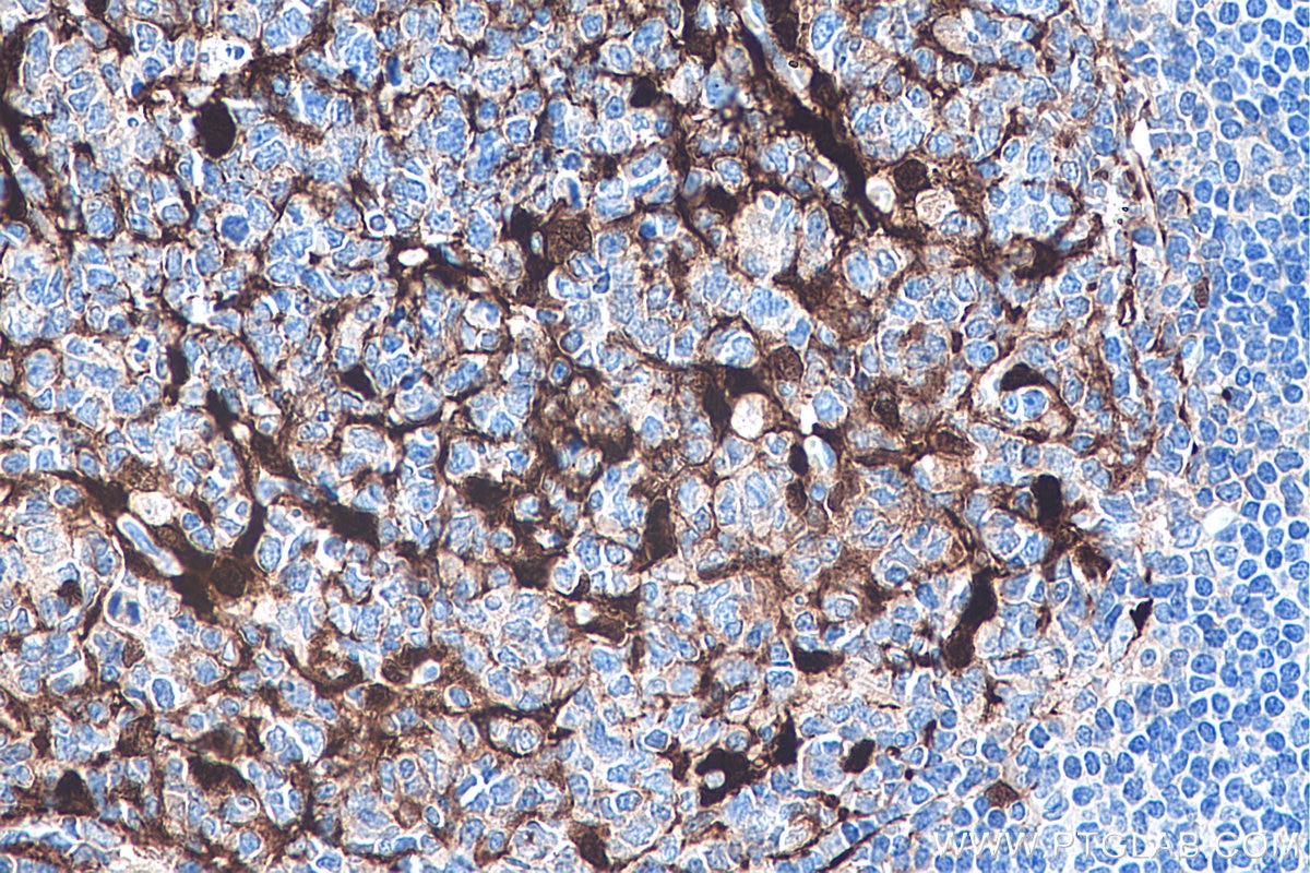 Immunohistochemistry (IHC) staining of human tonsillitis tissue using S100A1 Monoclonal antibody (67237-1-Ig)