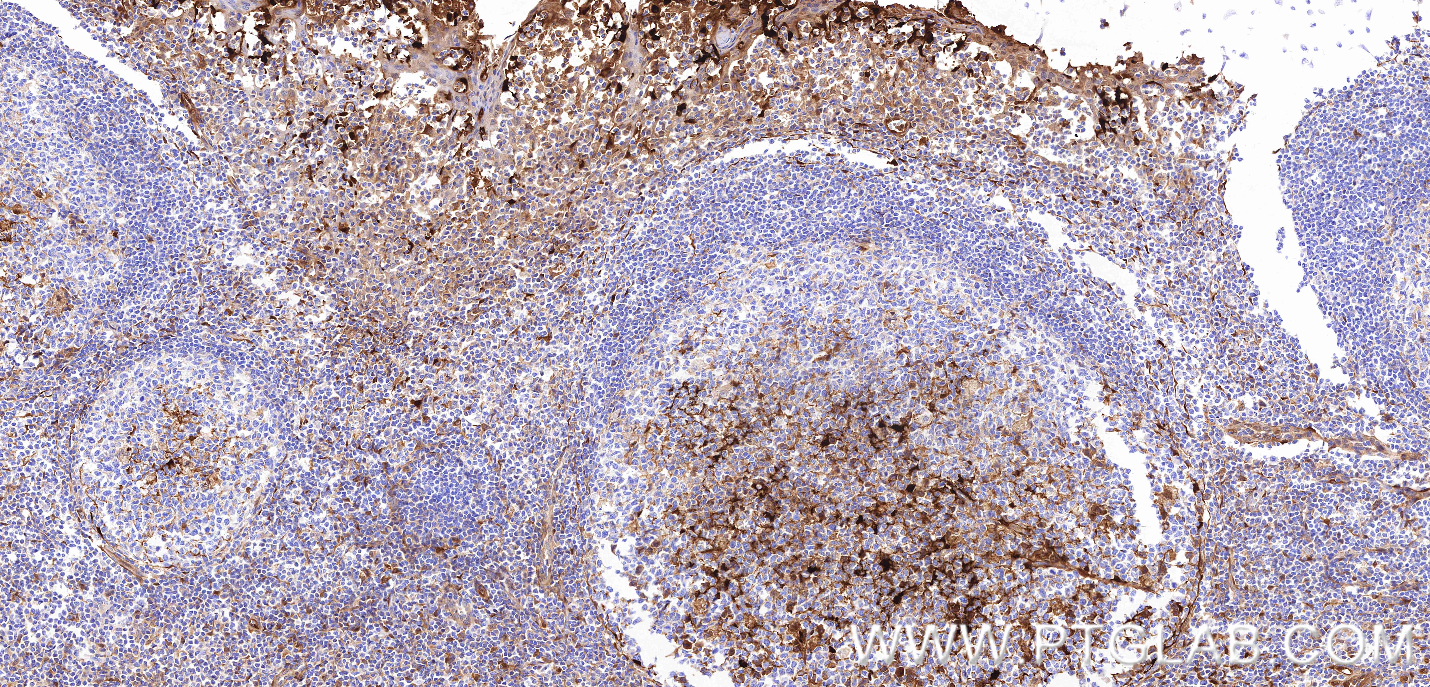 Immunohistochemistry (IHC) staining of human tonsillitis tissue using S100A1 Recombinant monoclonal antibody (88164-1-RR)