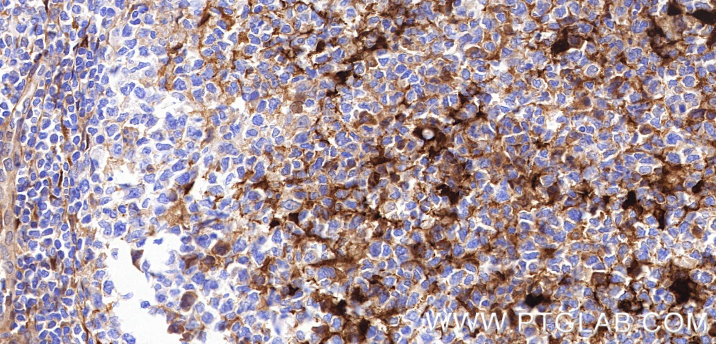 Immunohistochemistry (IHC) staining of human tonsillitis tissue using S100A1 Recombinant monoclonal antibody (88164-1-RR)