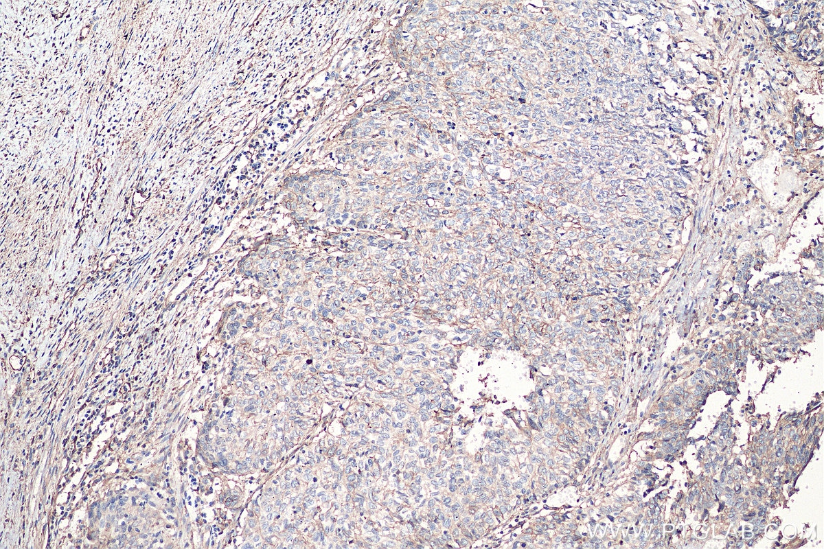 Immunohistochemistry (IHC) staining of human cervical cancer tissue using S100A10 Polyclonal antibody (11250-1-AP)