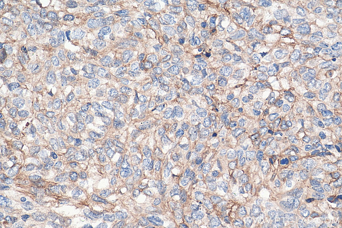 Immunohistochemistry (IHC) staining of human cervical cancer tissue using S100A10 Polyclonal antibody (11250-1-AP)