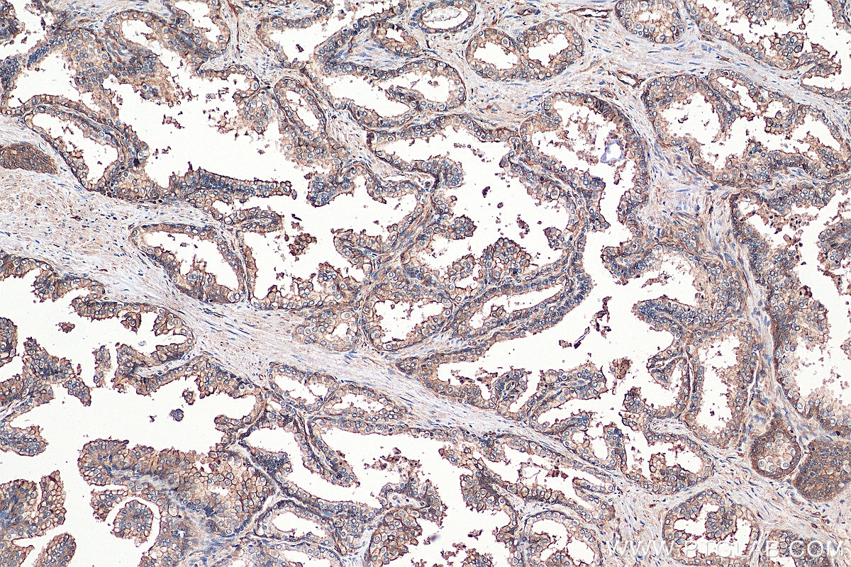 Immunohistochemistry (IHC) staining of human prostate hyperplasia tissue using S100A10 Polyclonal antibody (11250-1-AP)