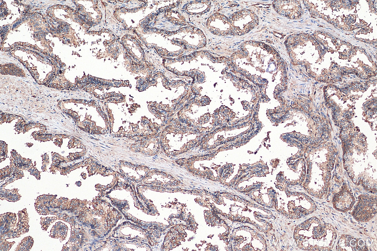 IHC staining of human prostate hyperplasia using 11250-1-AP