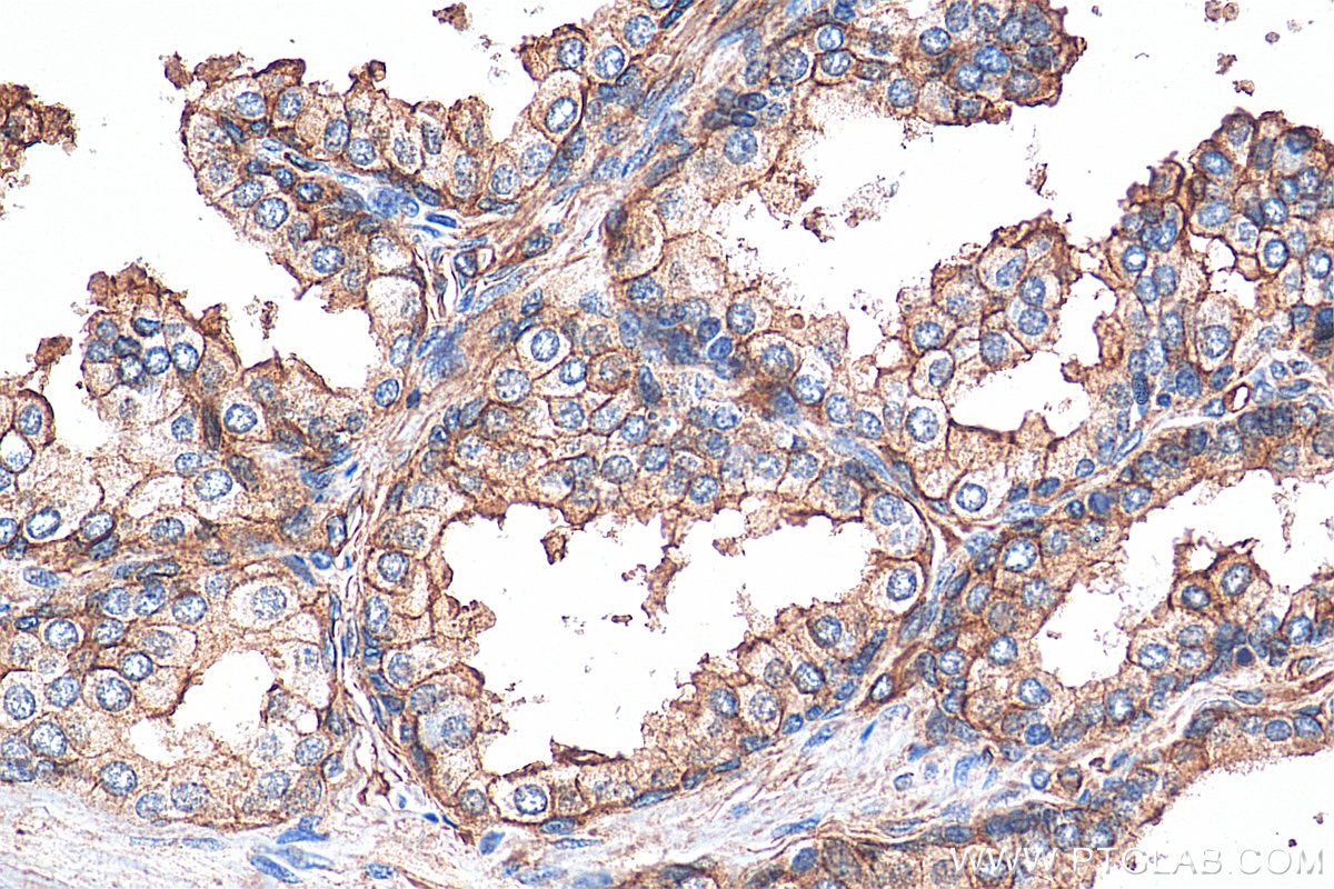 Immunohistochemistry (IHC) staining of human prostate hyperplasia tissue using S100A10 Polyclonal antibody (11250-1-AP)