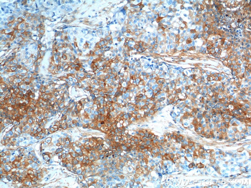 Immunohistochemistry (IHC) staining of human lung cancer tissue using S100A10 Polyclonal antibody (11250-1-AP)