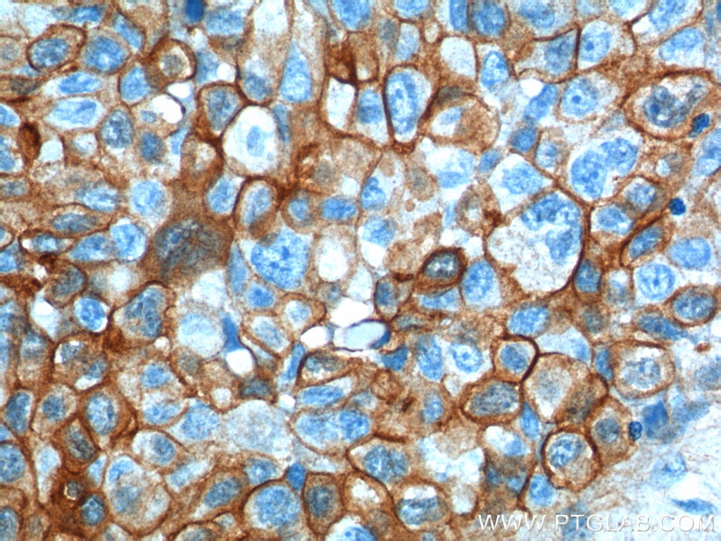 Immunohistochemistry (IHC) staining of human lung cancer tissue using S100A10 Polyclonal antibody (11250-1-AP)