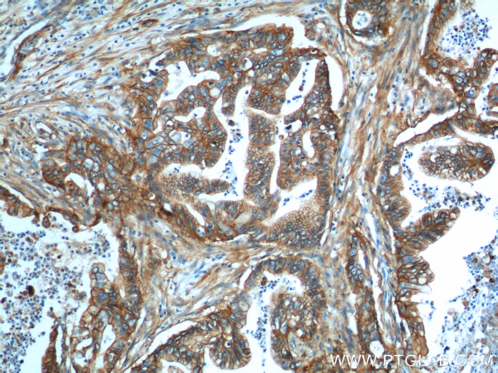 Immunohistochemistry (IHC) staining of human pancreas cancer tissue using S100A10 Polyclonal antibody (11250-1-AP)