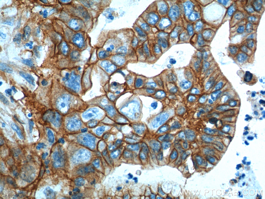 Immunohistochemistry (IHC) staining of human pancreas cancer tissue using S100A10 Polyclonal antibody (11250-1-AP)