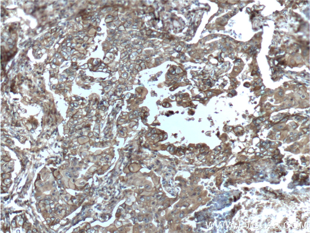 Immunohistochemistry (IHC) staining of human lung cancer tissue using S100A10 Polyclonal antibody (11250-1-AP)