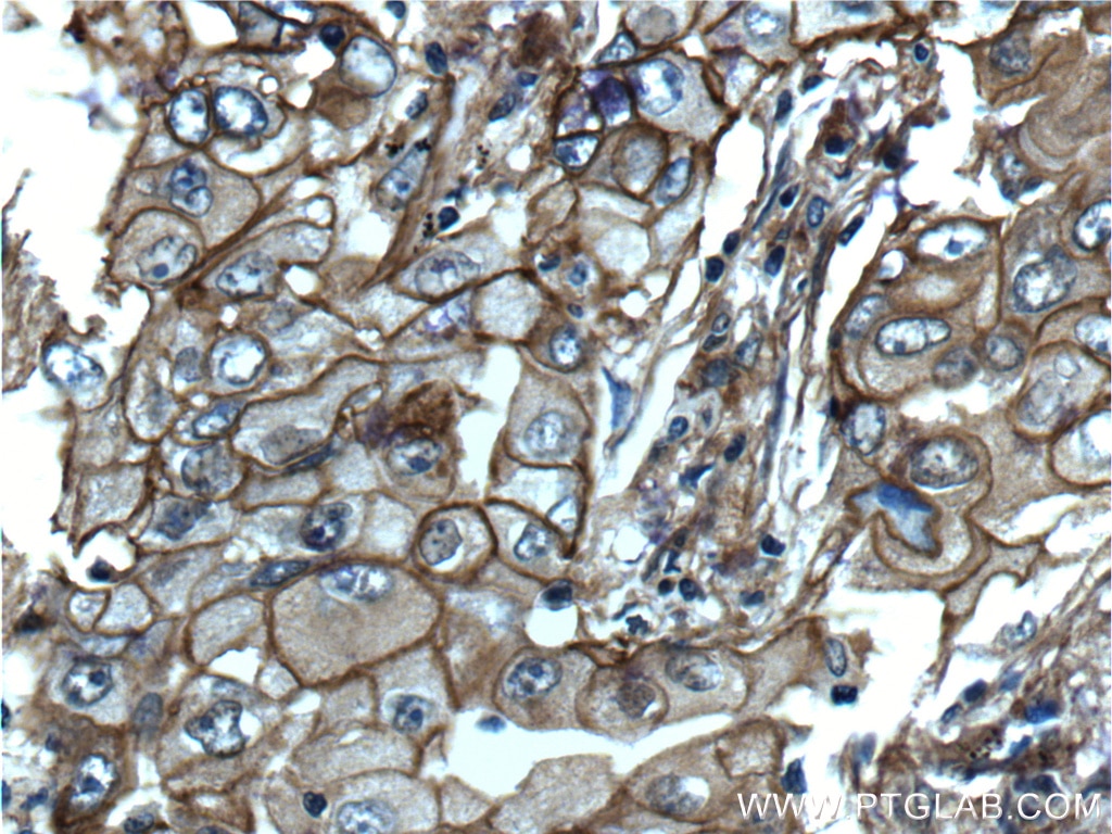 Immunohistochemistry (IHC) staining of human lung cancer tissue using S100A10 Polyclonal antibody (11250-1-AP)