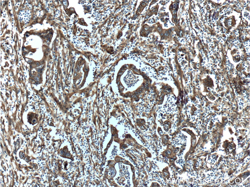 IHC staining of human pancreas cancer using 11250-1-AP