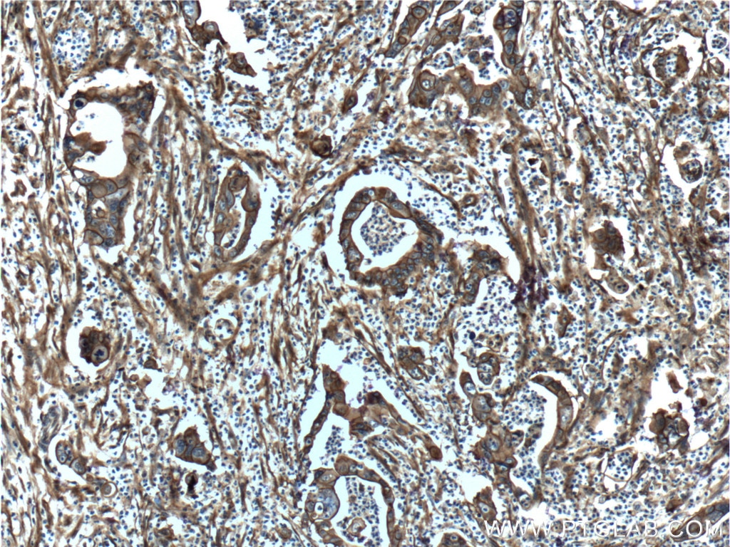 Immunohistochemistry (IHC) staining of human pancreas cancer tissue using S100A10 Polyclonal antibody (11250-1-AP)