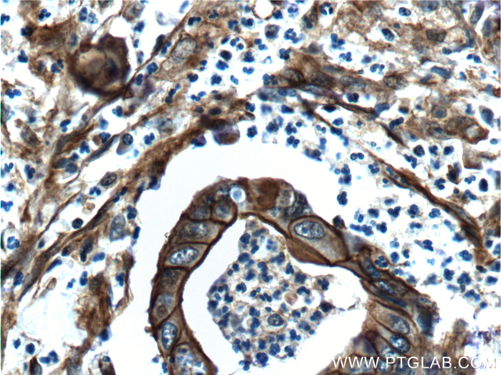 Immunohistochemistry (IHC) staining of human pancreas cancer tissue using S100A10 Polyclonal antibody (11250-1-AP)
