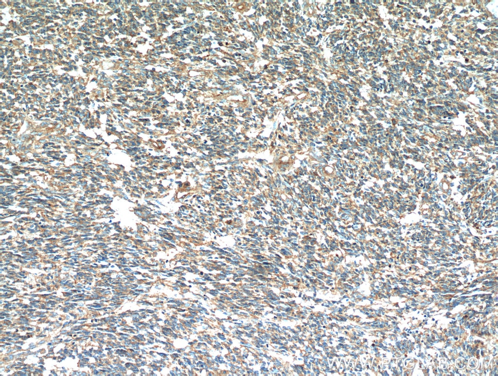 Immunohistochemistry (IHC) staining of human gliomas tissue using S100A10 Polyclonal antibody (11250-1-AP)