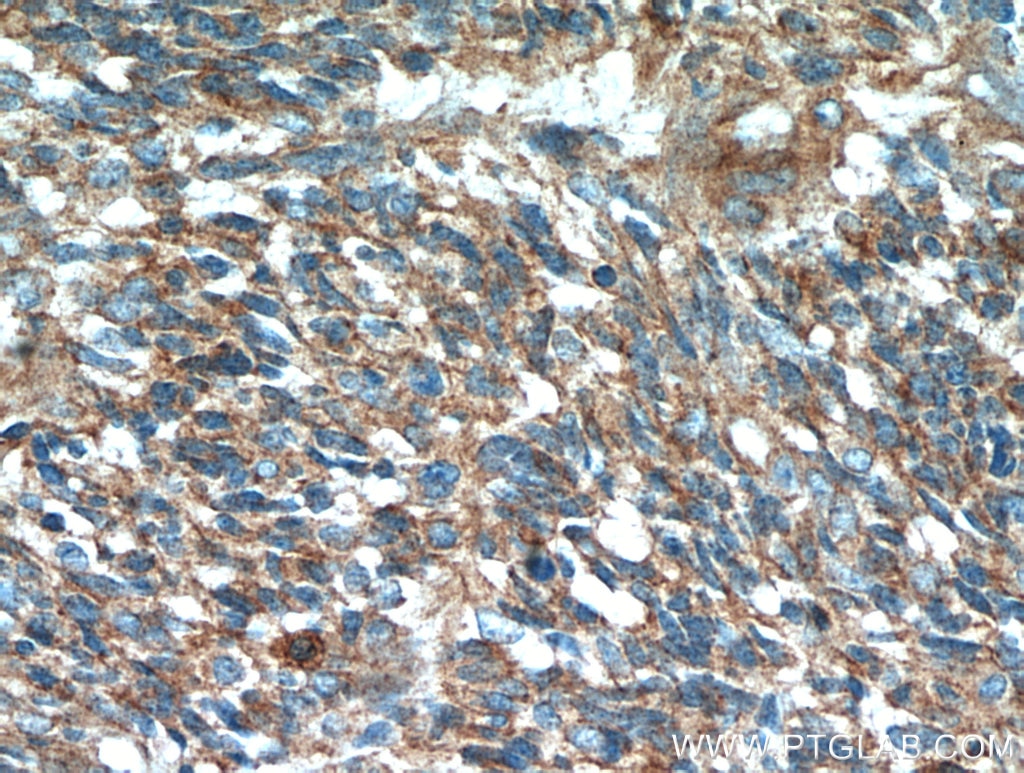 Immunohistochemistry (IHC) staining of human gliomas tissue using S100A10 Polyclonal antibody (11250-1-AP)